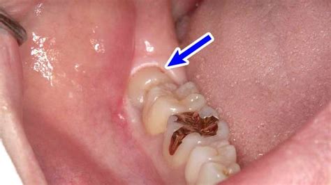 親知らずが痛い！親知らずの虫歯放置のリスクと治療について まつばら歯科口腔外科こども歯科