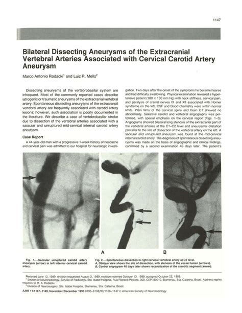 Bilateral Dissecting Aneurysms Of The Extracranial Vertebral Arteries