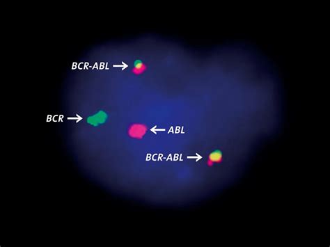 Understanding the BCR-ABL Translocation: The Philadelphia Chromosome ...