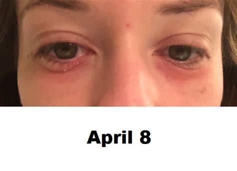 Rashes Around The Eye Renew Physical Therapy