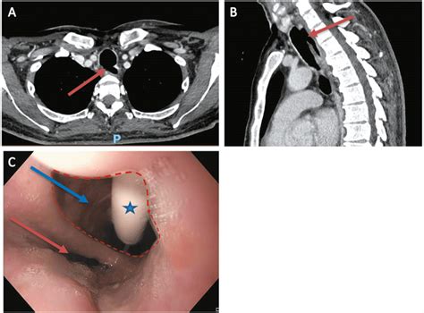 Iatrogenic Tracheoesophageal Fistula After Emergency Orotracheal