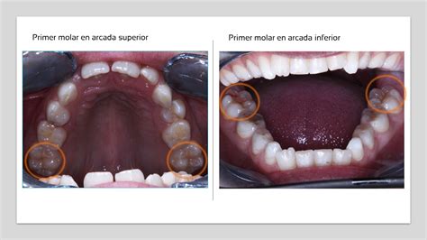 Qu Es El Molar De Los A Os