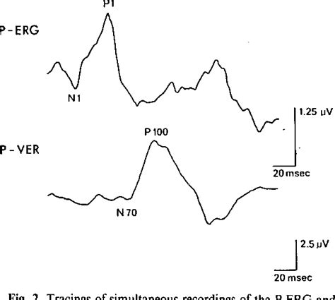 Figure 2 From Simultaneous Pattern Reversal ERG And VER Recordings