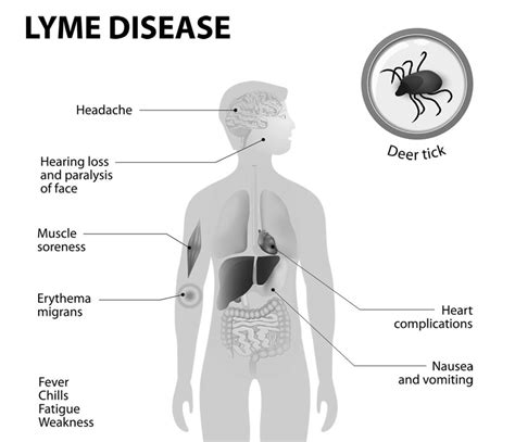 Stop Tick Bites To Prevent Lyme Disease Minnesota Counties Intergovernmental Trust