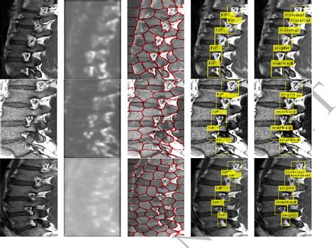 Figure 1 From Automated Neural Foraminal Stenosis Grading Via Task