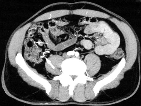 Accuracy Of Helical Computed Tomographic Angiography For The Diagnosis