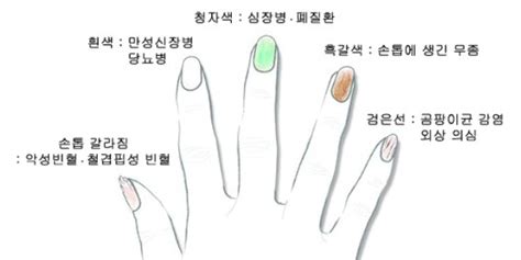 손톱으로 보는 건강상태 알아보기 네이버 블로그