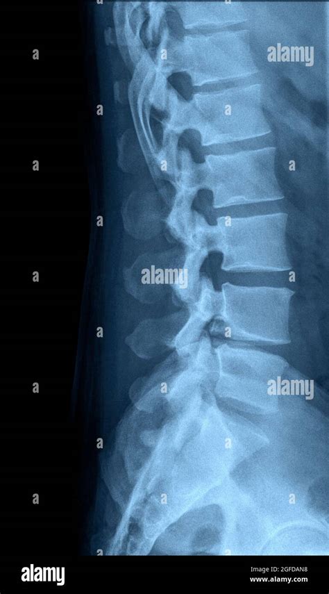 Lumbar Spine X Ray Anatomy