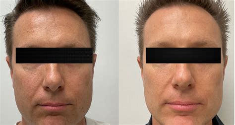 Before And After Advanced Laser Skin Clinic Tattoo Removal