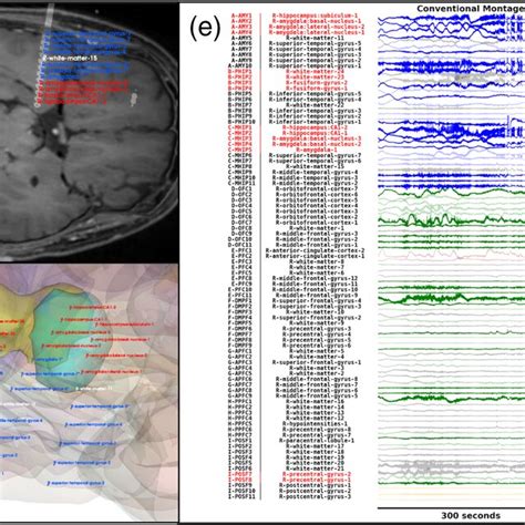 Demonstration of the anatomical framework for a subject suffering from ...