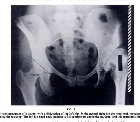 Congenital Dislocation Semantic Scholar