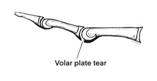 Volar plate injury | The British Society for Surgery of the Hand