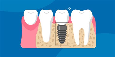 Cleaning And Caring For Dental Implants SmartMouth