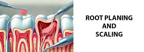 The Root Planing And Scaling Guide Including Costs