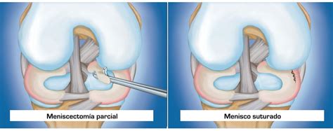 C Mo Saber Si Tengo El Menisco Roto Tengo Que Operarme