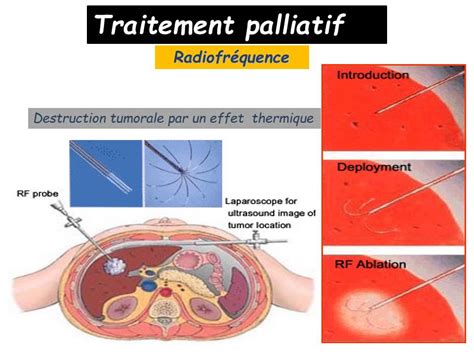 Gastro Enterologie Cancers Du Foie Youtube