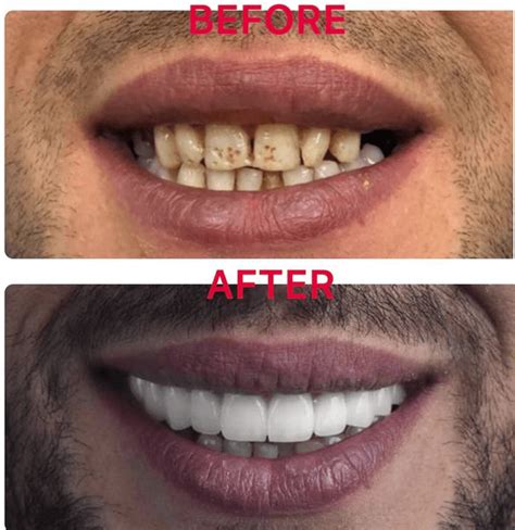 Before & After – Smartdent