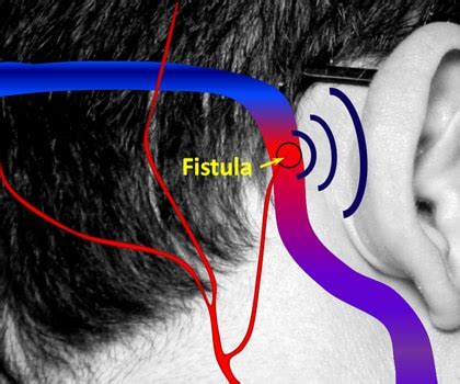 Dural Arteriovenous Fistula | Vascular Interventions Hyderabad