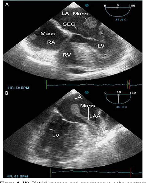 Figure 1 From Multisided Cardiac Hemangiomas Mimicking Biatrial