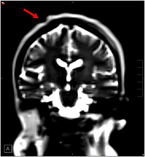 A Case Of Cutis Verticis Gyrata Developing In A Patient With Primary