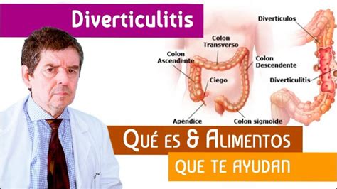 Alimentos Para La Diverticulitis Actualizado Diciembre 2024