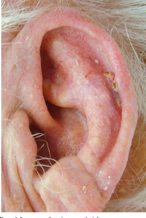 Figure 1 From Squamous Cell Carcinoma Of The Auricle And Mohs