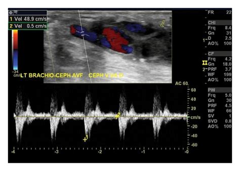 Dialysis Graft Ultrasound