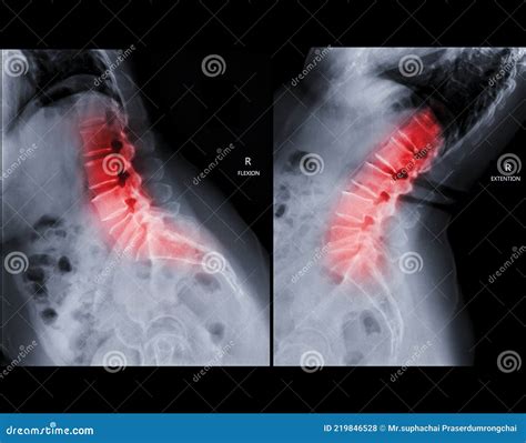 Lateral Flexion Spine