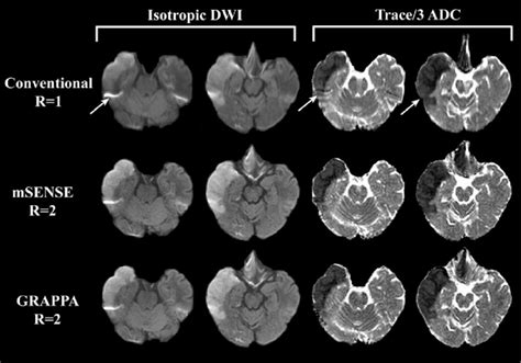Two Axial Dwi B1000 Smm 2 Sections And Corresponding Trace3 Adc
