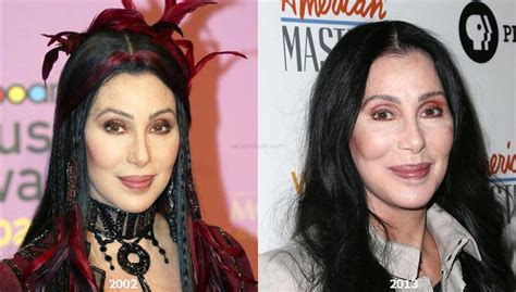 Cher Plastic Surgery Before and After – Celebrity Dr.