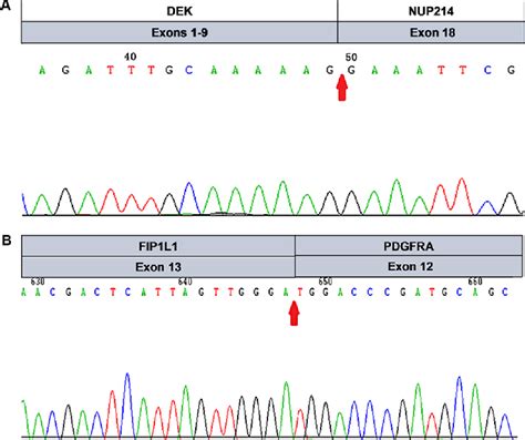 Figure 3 From Imatinib Therapy In Acute Myeloid Leukemia With Dek