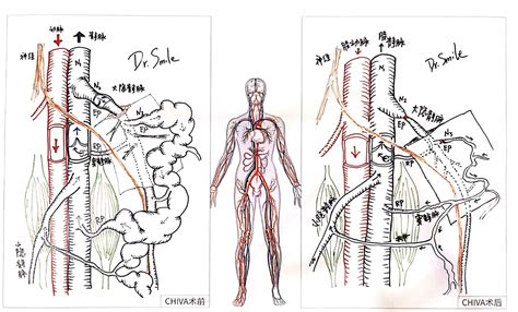 医疗服务 下肢静脉曲张chiva治疗 张强医生集团dr Smile Medical Group官方网站