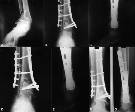 A G A Tibial Pilon Fracture Type 43c2ao Bc Osteosynthesis By