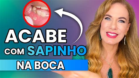 ACABE A CANDIDIASE ORAL Ou SAPINHO Na BOCA 3 DICAS NATURAIS