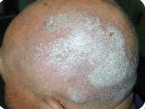 Psoriasis of the Scalp: Scalp Psoriasis, Psoriatic Dandruff and Flaking