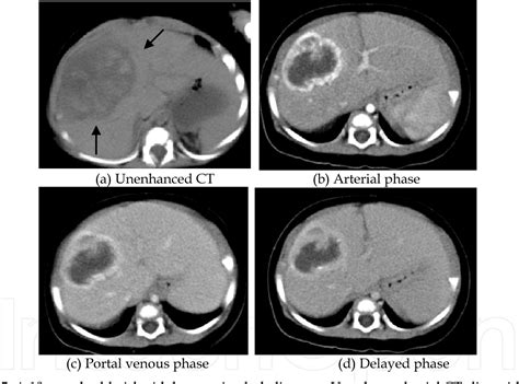 Liver Mass Ct Scan