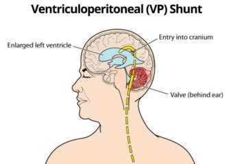 Best Vp Shunt Surgery Cost In India Success Rate