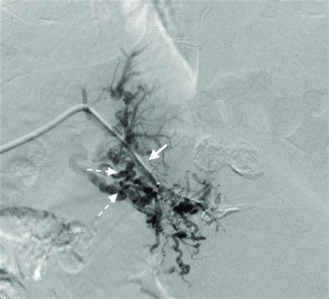 Portal Venogram Showing Advancement Of 5 French Catheter Through