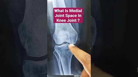 What Is Medial Joint Space In Knee Joint Dr Sai Chandra Mbbs Dnb