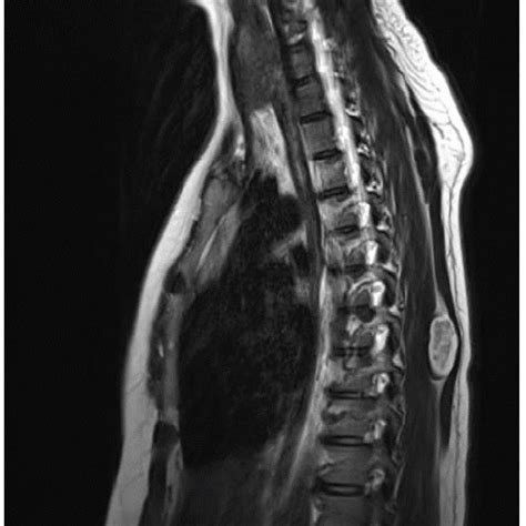 Pdf An Uncommon Tumor Paraspinal Schwannoma