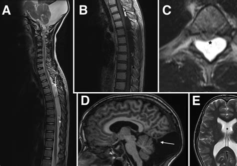 Occurrence Of Spinal Extradural Arachnoid Cysts In A Child With