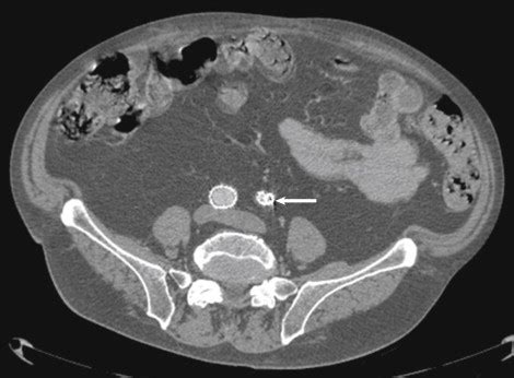 Endovascular Treatment of Aneurysms of the Infrarenal Aorta | Thoracic Key