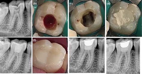 Pulpotomy In Mature Permanent Teeth A New Era Of Minimally Invasive