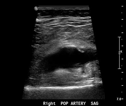 Popliteal Artery Aneurysm Image Radiopaedia Org