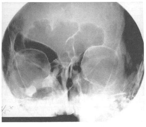 Figure 1 from Nevoid Basal Cell Carcinoma Syndrome Presenting as ...