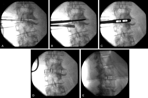 Lateral Lumbar Interbody Fusion Clinical Tree