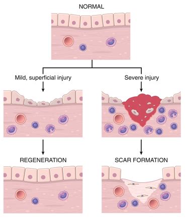 Inflammation And Repair Flashcards Quizlet