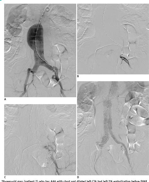 Figure From Internal Iliac Artery Embolization During An Endovascular