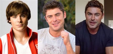 Zac Efron Explicó El Drástico Cambio Que Experimentó Su Rostro Sufrió