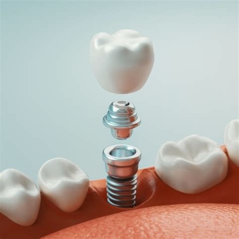 Dental Implants Jacksonville Dental Excellence Missing Teeth Cost